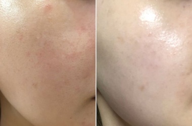  Regenerace pleti, po 2 ošetřeních