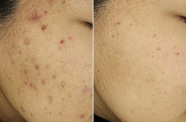 Léčba akné, po 3 ošetřeních